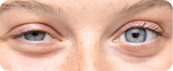 Ptose Palpebral
